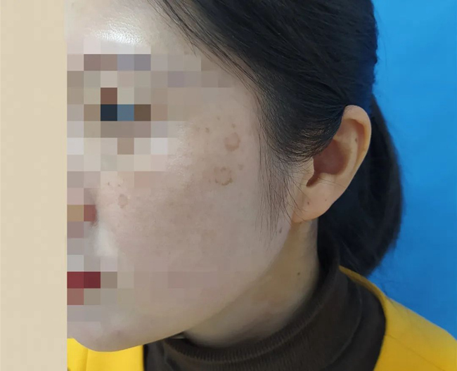 中, 밤샘으로 검버섯이 생긴 27세 여성 “새벽 2시 이전에 잠든 적 없어”
